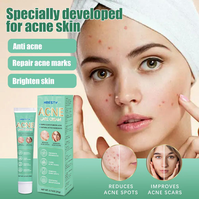 Acne Pimple treatment